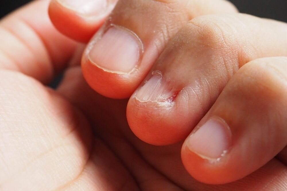 Dermatology: What causes hangnails and how do you get rid of them? - Quora